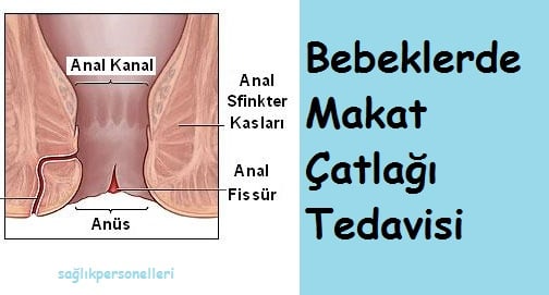 Bebeklerde Makat Çatlağı Tedavisi