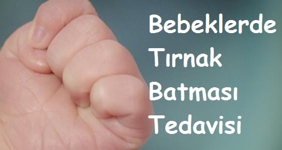 Bebeklerde Tırnak Batması Tedavisi