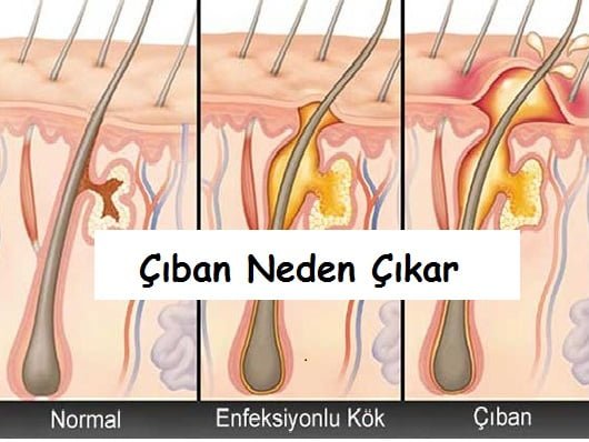 çıban neden çıkar