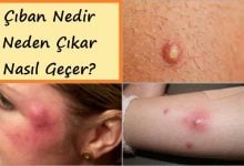 Çıban Nedir, Neden Çıkar ve Nasıl Geçer?