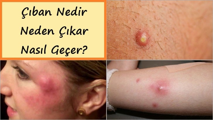 Çıban Nedir, Neden Çıkar ve Nasıl Geçer?