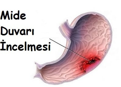 Mide Duvarı İncelmesi Tedavisi