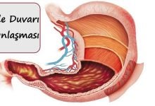 Mide Duvarı Kalınlaşması