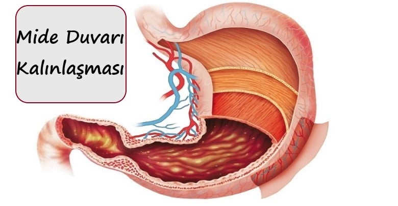 Mide Duvarı Kalınlaşması