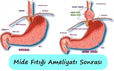 Mide Fıtığı Ameliyatı Sonrası