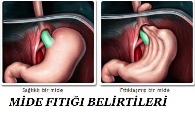 mide fıtığı belirtileri