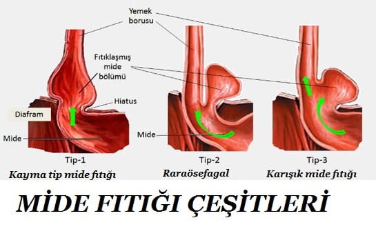 mide fıtığı çeşitleri