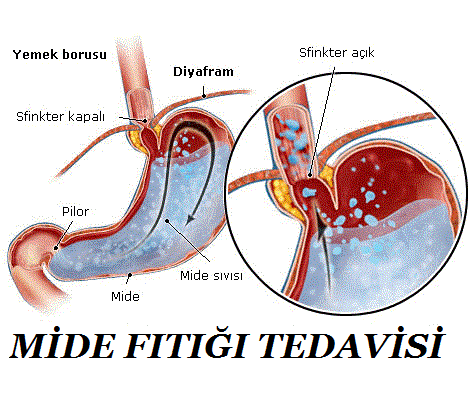 mide fıtığı tedavisi