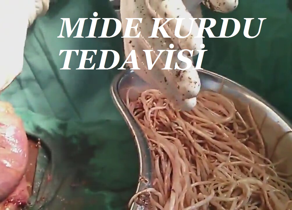 mide kurdu tedavisi