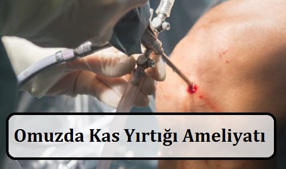 Omuzda Kas Yırtığı Ameliyatı