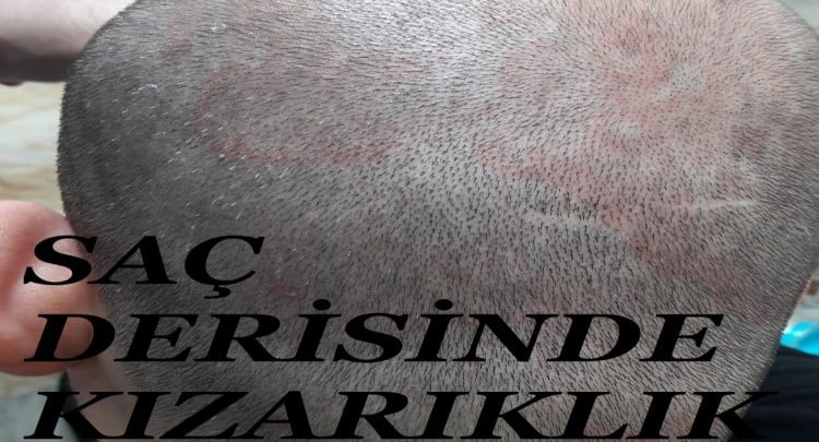 saç derisinde kızarıklık