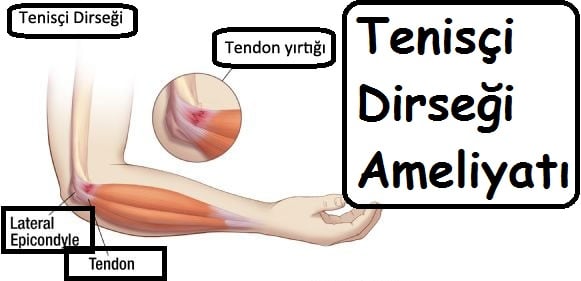 Tenisçi Dirseği Ameliyatı